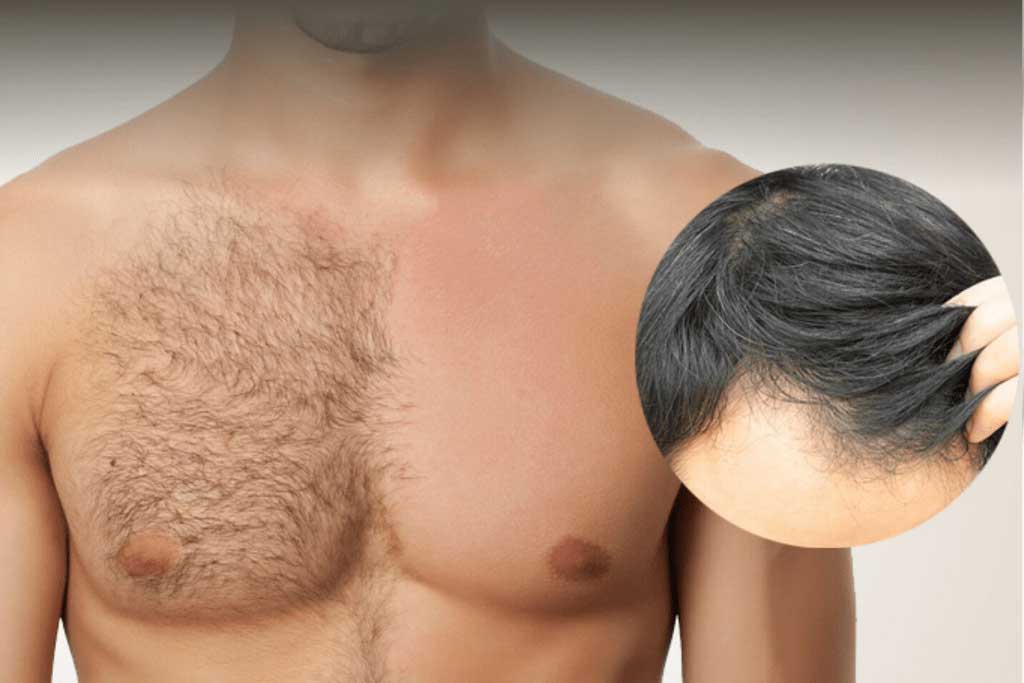 Body hair transplant