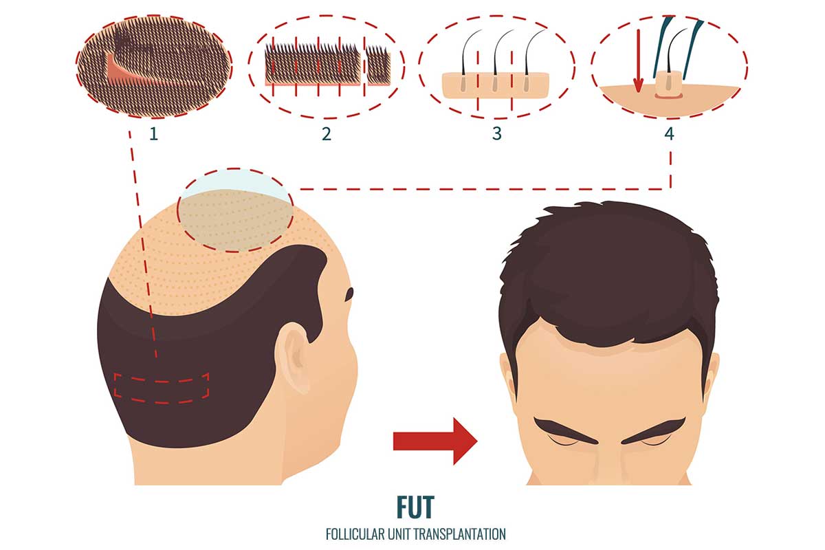 FUT hair transplant in Turkey